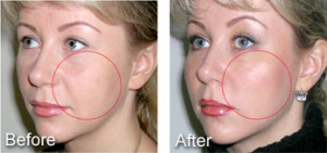 before and after facial threads
