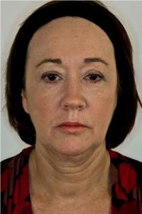 midface-after