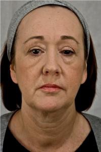midface-before